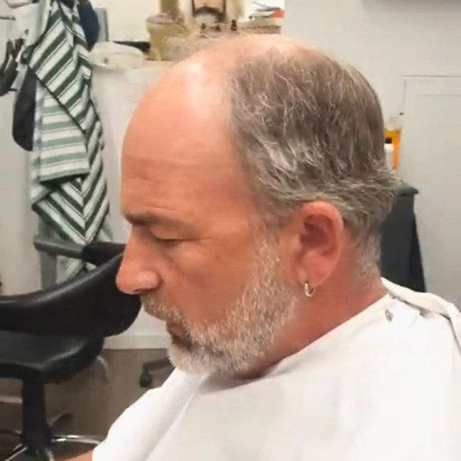 Antes Prótesis y pelucas